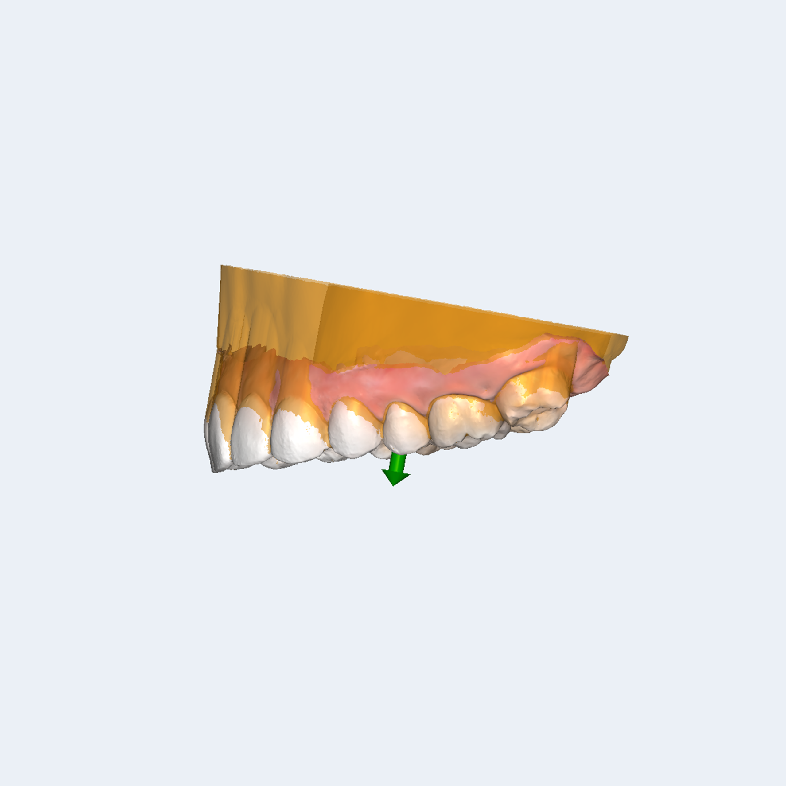 RAYDENT Splint - Image 2
