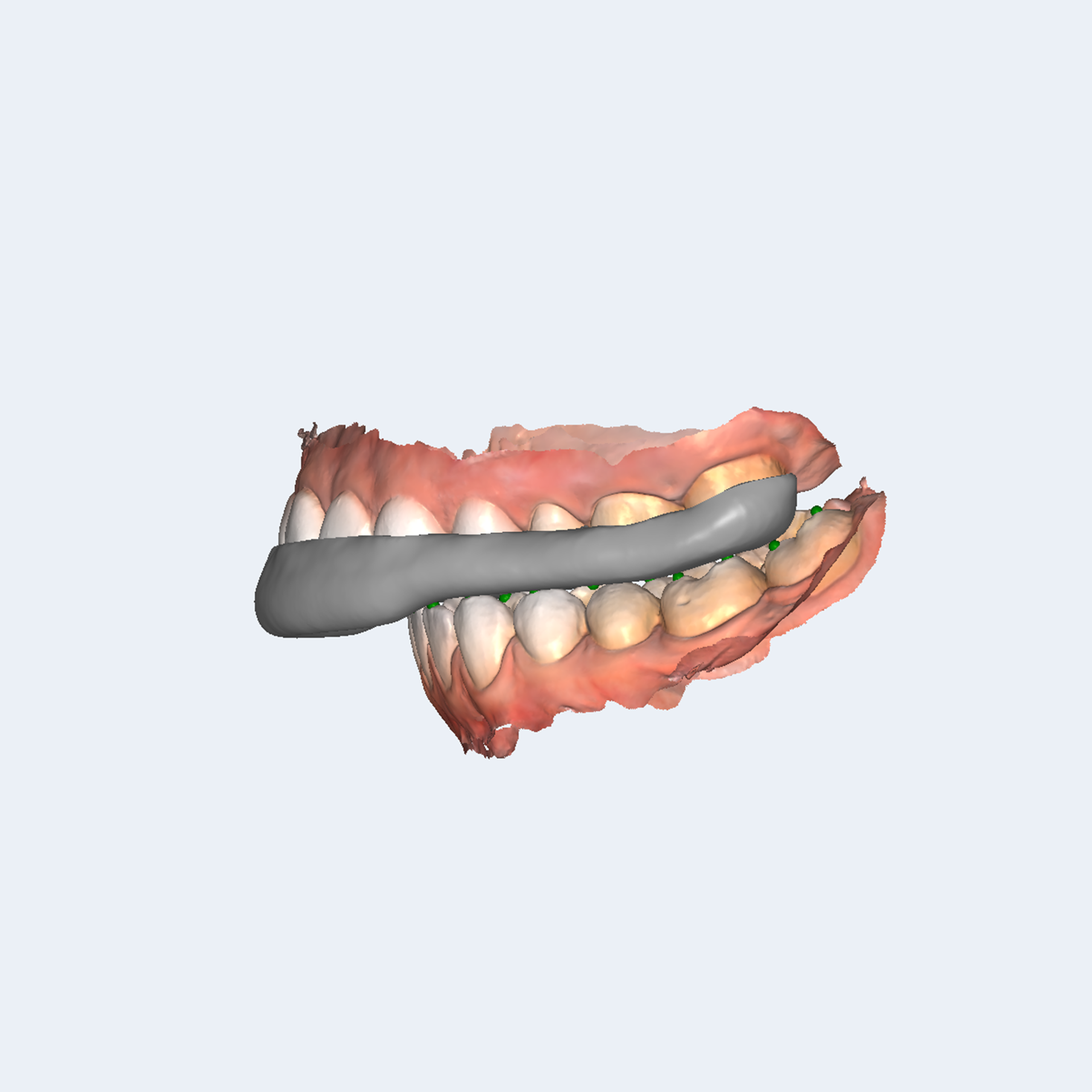 RAYDENT Splint - Image 4